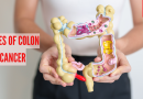 कोलन कॅन्सरची लक्षणे: कोलन कॅन्सरचे 4 प्रकार: लक्षणे, कारणे आणि उपचार