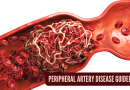 क्लीव्हलँड क्लिनिक परिधीय धमनी रोग काळजीसाठी नवीन मार्गदर्शक तत्त्वे तयार करण्यात मदत करते |