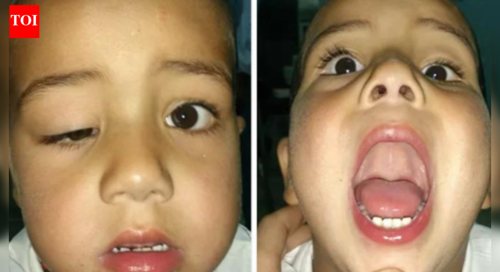 मार्कस गन सिंड्रोम म्हणजे काय, ज्यामध्ये पापणी जबड्याने हलते: धोके आणि वारसा समजून घेणे