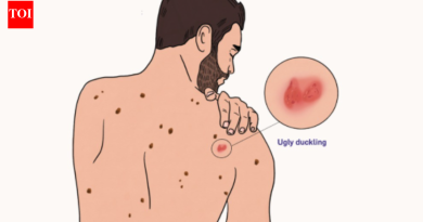 मेलेनोमासाठी बदकाचे कुरूप चिन्ह: लक्षणे, अभ्यास आणि स्वत: ची तपासणी टिपा